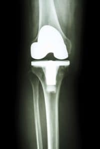 Zimmer Initiates Class 2 Recall of Persona Trabecular Metal Tibial Plate
