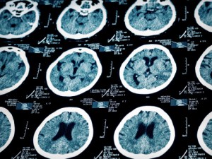 Maryland brain injury lawyers