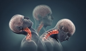 Neck Injuries From Car Accidents in Maryland