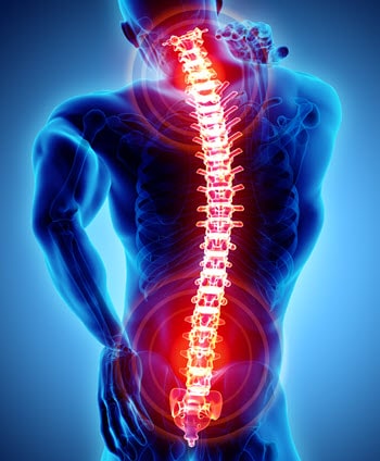 SSDI for Back Pain