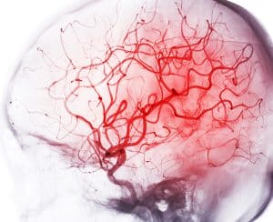 What Is a Brain Bleed?