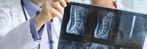 Spinal Fusion